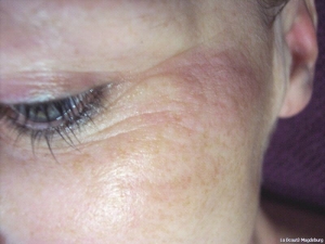 Lifting vorher und nachher