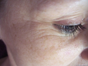 Lifting vorher und nachher