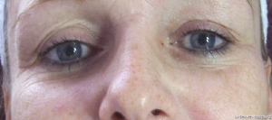 Lifting vorher und nachher