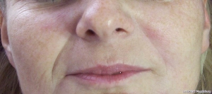 Lifting vorher und nachher