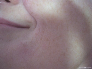 Lifting vorher und nachher