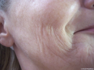 Lifting vorher und nachher